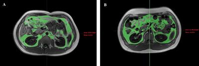 Intermuscular Fat Content in Young Chinese Men With Newly Diagnosed Type 2 Diabetes: Based on MR mDIXON-Quant Quantitative Technique